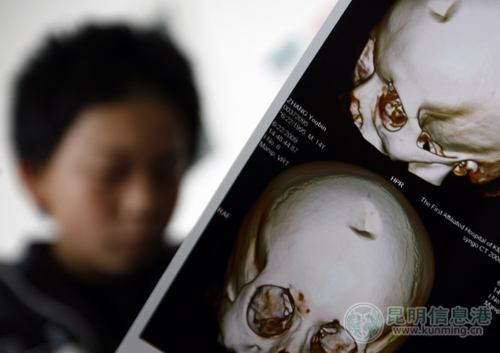 14岁男孩被石块击中 头骨凹陷骨折风险大(图)