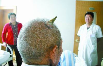 河南<em>一</em>88岁老人头上长 犄角 医生检查称是<em>挠</em>的