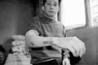 殷师傅右臂多处受伤 沈文林 摄 殷师傅右臂多处受伤 沈文林 摄