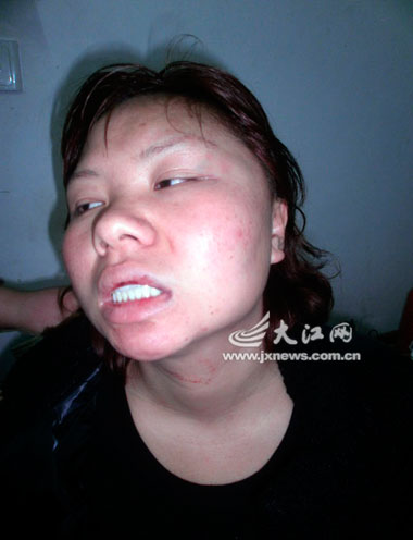 张女士左侧脸部青紫肿胀,腿部膝盖部位也是一片青紫 张女士左侧脸部青紫肿胀,腿部膝盖部位也是一片青紫