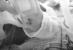 娜娜身上出现上百处伤痕 娜娜身上出现上百处伤痕