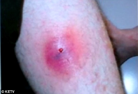 被隐士蜘蛛咬伤处会出现红色肿胀，中间突起会形成似火山口形状的伤口