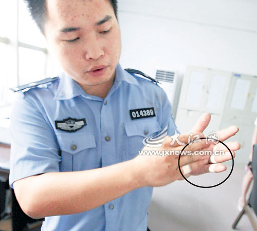 民警手上多处割伤 民警手上多处割伤