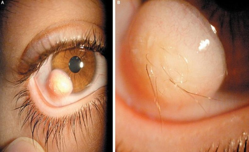 伊朗男子患罕见疾病眼球长毛发 影响其视力(图)