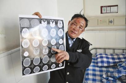 被撞后,黄月华脸上出现多处擦伤 被撞后,黄月华脸上出现多处擦伤
