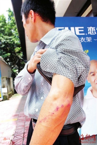 收费员小林身上多处受伤 收费员小林身上多处受伤