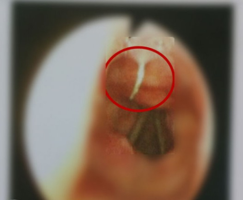 苏先生将金属鱼钩吞下肚,卡在了会厌根部,已经贯穿至喉面。 苏先生将金属鱼钩吞下肚,卡在了会厌根部,已经贯穿至喉面。