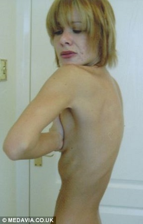 由于疯狂节食,琳恩患上厌食症。至26岁时,她的体重只有不到29公斤,曾三度入院治疗。 由于疯狂节食,琳恩患上厌食症。至26岁时,她的体重只有不到29公斤,曾三度入院治疗。