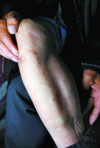 子弹就是从腿底下穿过来的”,老人用手比划着。抗战中康玉先双腿都被子弹贯通,过去70年了,还能看到伤痕。 子弹就是从腿底下穿过来的”,老人用手比划着。抗战中康玉先双腿都被子弹贯通,过去70年了,还能看到伤痕。