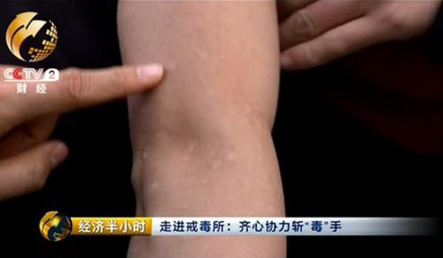 小云的胳膊上布满伤疤,吸食冰毒后她在幻觉中把皮肤扣得鲜血淋漓.