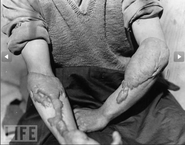 美刊披露广岛长崎遭原子弹袭击后惨况照片图6