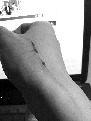 男子家中遭蝙蝠入侵捕捉不成反被抓伤