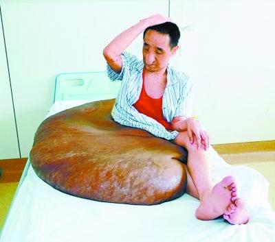 男子腰上长200斤肿瘤医生花16小时摘除图