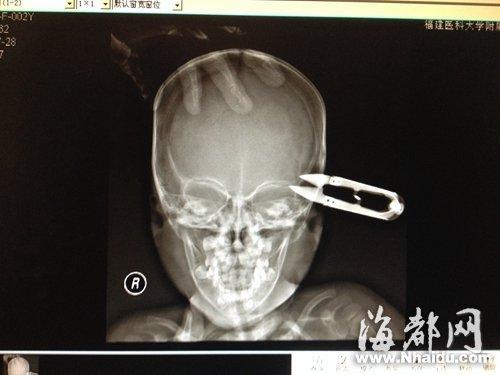 x光片显示,剪刀已刺破颅骨,扎入脑组织被拔出的裁缝剪关注理由一不