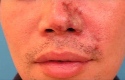 台男生为变李敏镐追学妹整容鼻子险废掉图