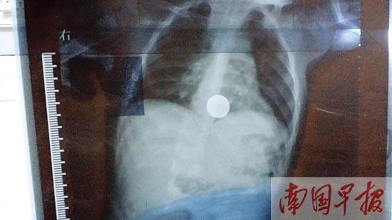 ������ͯ��ʳһԪӲ�ұ���ҽ ���ﲻȡ���