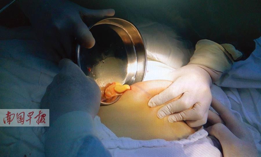 北海一女子打针隆鼻 不料植入的物质流到鼻子两侧