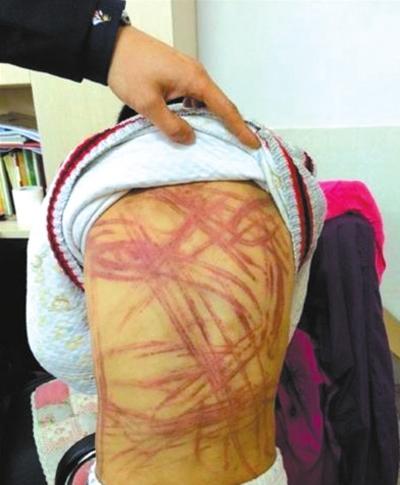 施某某被打得遍体鳞伤。网络截图