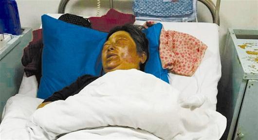 女子因吃野菜中毒晒太阳后头脸发肿图