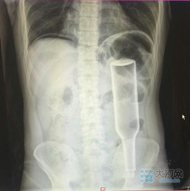 郑州男子玩刺激将花露水瓶插入肛门 戳破肠子险致命