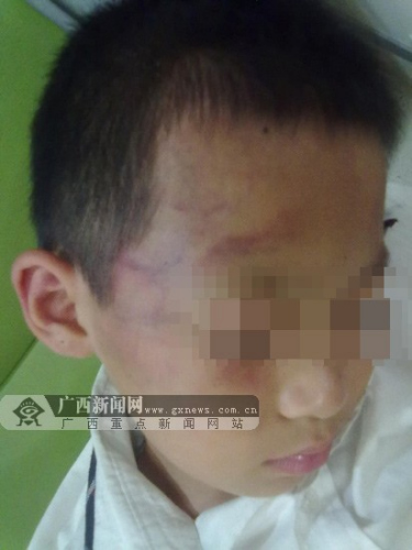 小学生在校被老师掌掴面部淤血学校:已协商赔偿