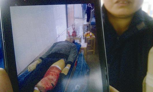骨折病人手术大出血死亡疑因医生切断大动脉(图)