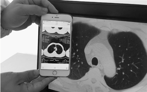 男子8岁开始抽烟每天一两包44岁长80岁肺(图)