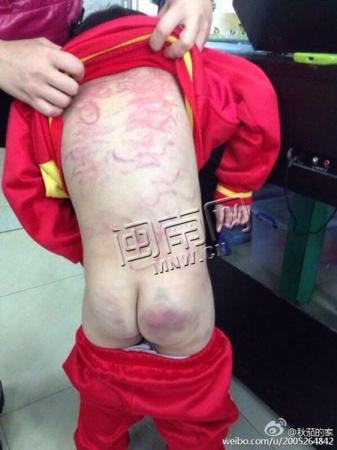 福建惠安一母亲“衣架教育”5岁女孩满身伤痕(图)