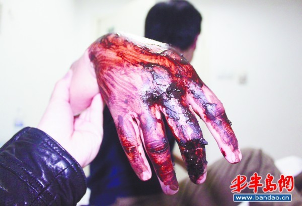 大二生帮宠物眼镜蛇蜕皮遭咬伤熟知自救知识保命