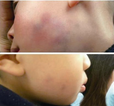 3岁男孩哭闹不肯午睡脸被老师捏出多处乌青图