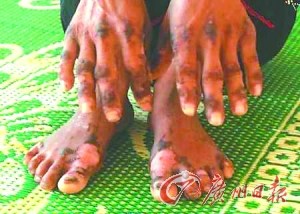越南现神秘皮肤病数百人手脚感染死亡率高(图)