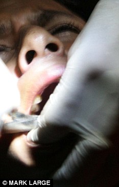 女牙医报复负心前男友加大麻醉拔光其满嘴牙齿