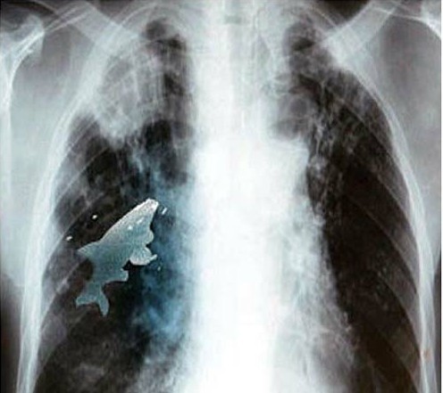 男童不慎将鱼吸入肺中9厘米小鱼肺中存活(图)