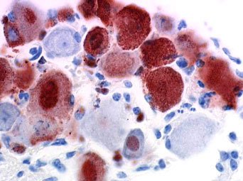 美国狂犬病患者死后器官移植给4人已致1人死亡