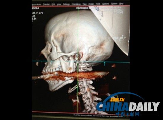 鱼叉误射入嘴奇迹生还巴西女子距死神仅一厘米