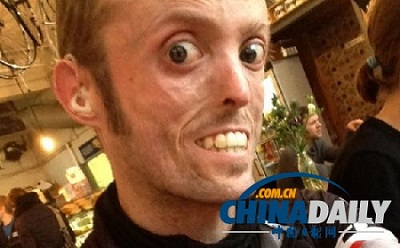 基因组测序技术破解英国残疾赛车手暴瘦之谜(图)