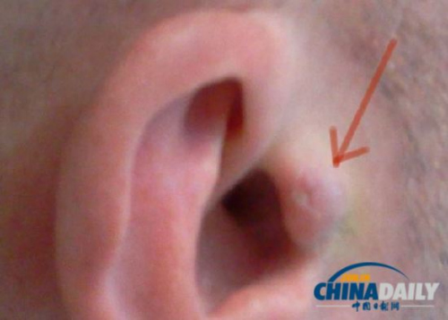 男子将“耳机”植入耳朵随时随地听歌(图)