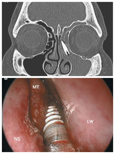 女子左脸痛2年求医医师从中取出2公分螺丝