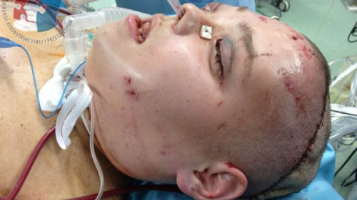 波兰女子脸部长肿瘤“有口难言”做变脸手术(图)