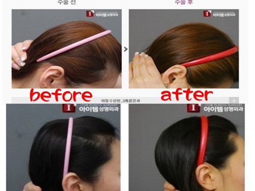 韩国后脑勺整形效果惊人存风险医生吁谨慎(图)