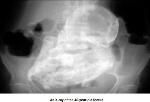 82岁老妇腹腔“石胎”形成40年未察觉(图)