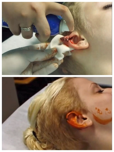 女子自认前世是仙女耳朵整形成似精灵5