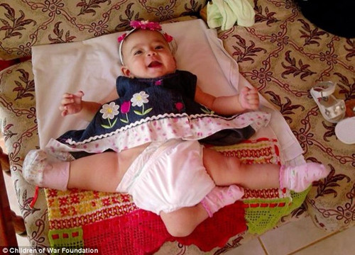 “三腿女婴”赴美接受免费治疗体内还有三个肾