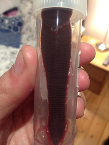 英一女子流鼻血一个月鼻腔中现食指长蚂蝗(图)