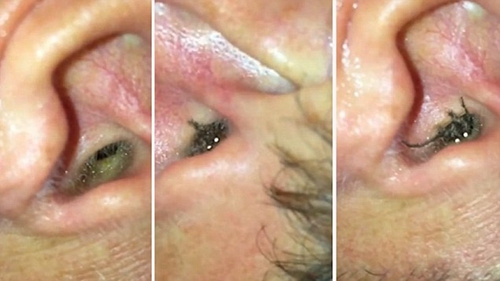 惊悚:男子耳部不适发现竟有蜘蛛爬进爬出(图)