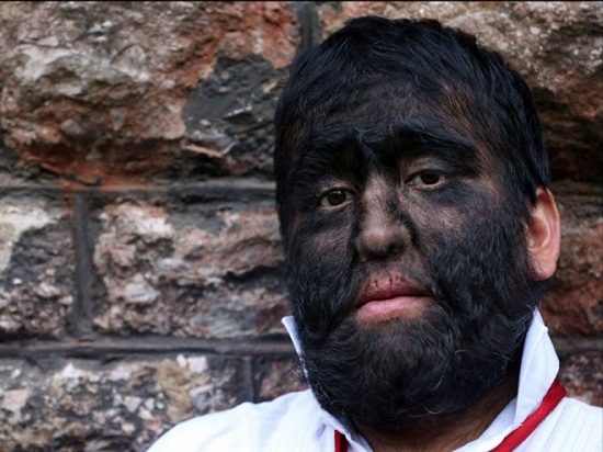 墨西哥一家患多毛症满脸黑发 世界最"毛"家族