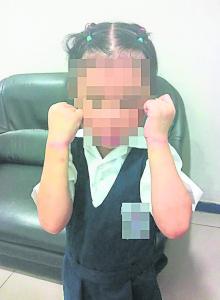 大马华裔女童因拿同学橡皮擦被校方捆住双手施惩