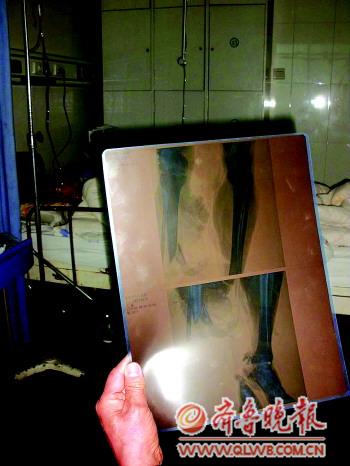 男子逃票翻护栏被火车轧断腿家属称其曾患精神病