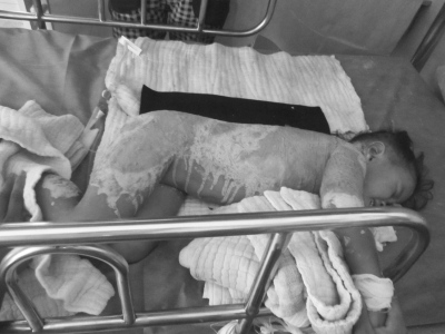 3岁女孩摔进热水盆全身大面积烫伤无钱医治(图)