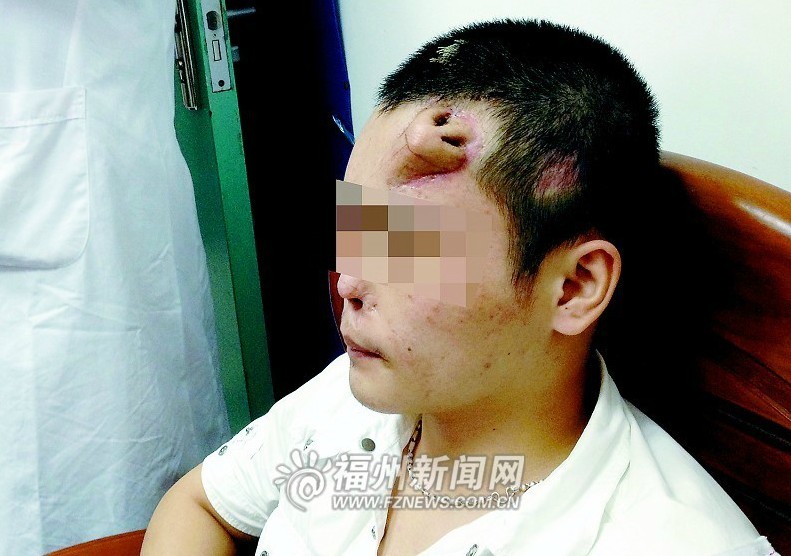 小伙因车祸鼻部受伤医生在额头“种出”新鼻子